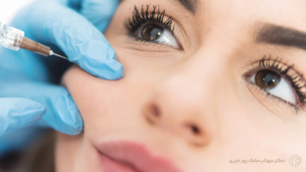 تزریق ژل گونه با کانولا