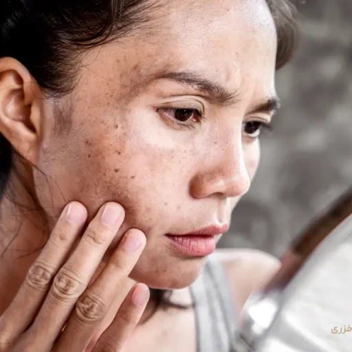 مراقبت از پوست در نوجوانان